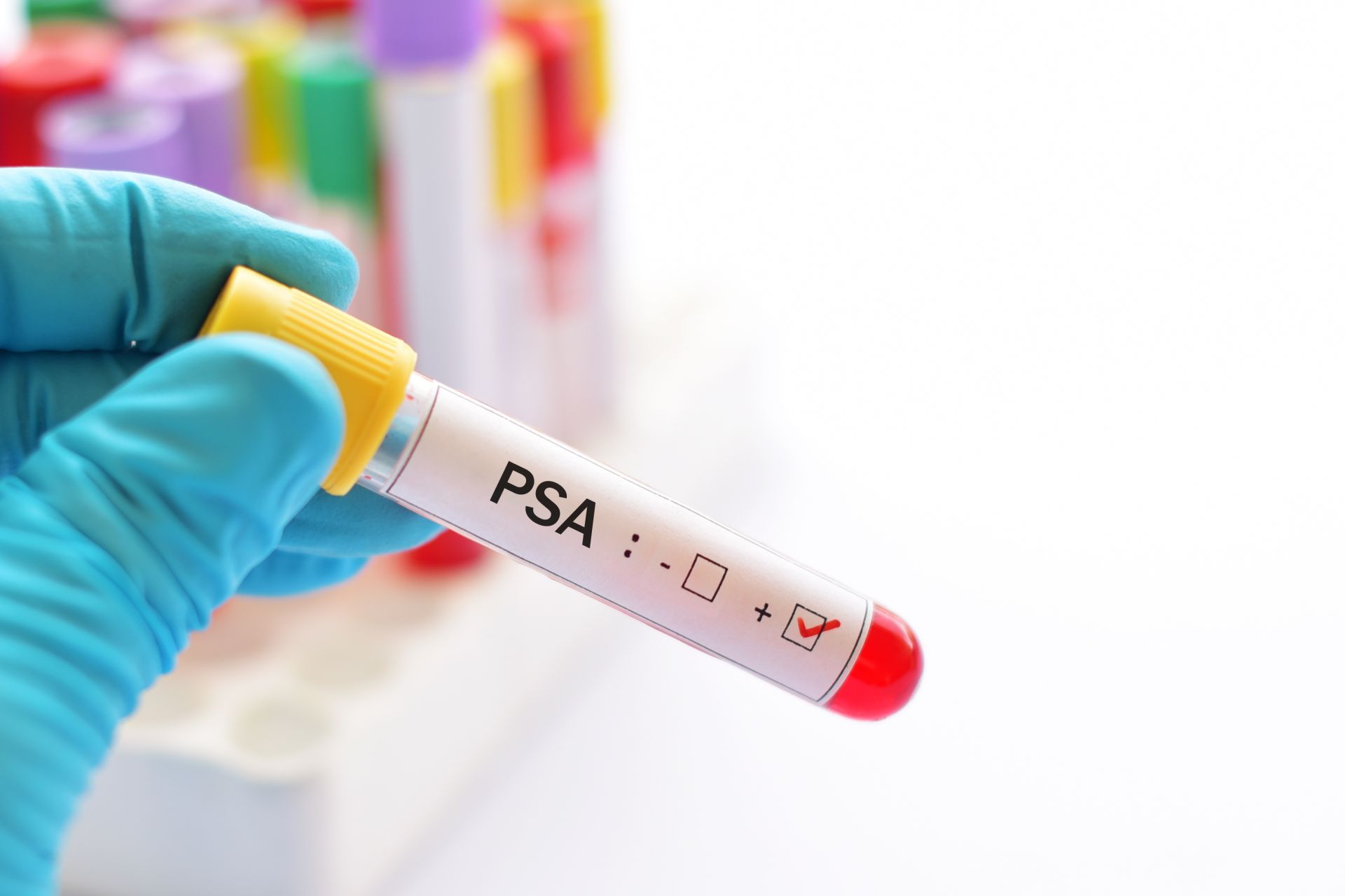 Analize Medicale - PSA (antigen specific prostatic) si free-PSA