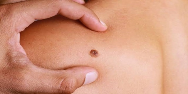 Atenção dobrada: é hora de se prevenir contra o câncer de pele
