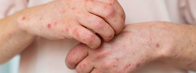 Monkeypox: sintomas e prevenção da varíola dos macacos