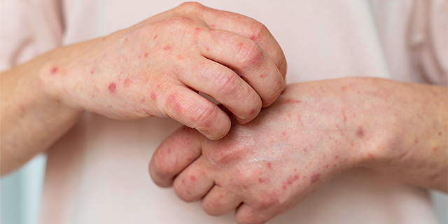 Monkeypox: sintomas e prevenção da varíola dos macacos